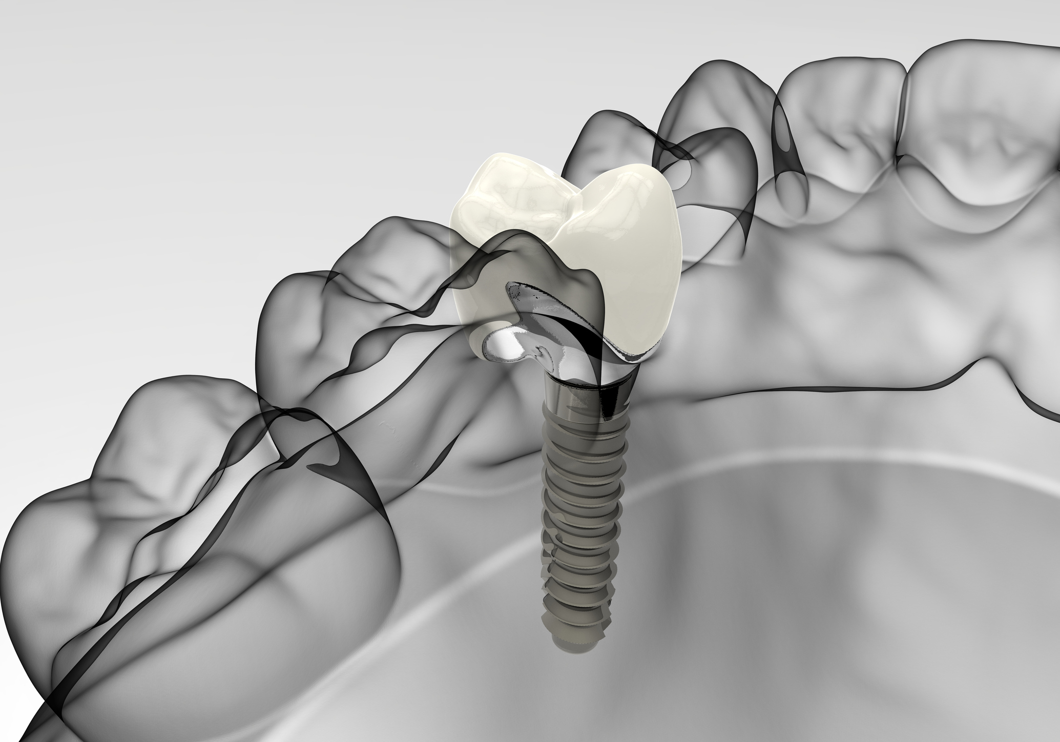Dental Implants